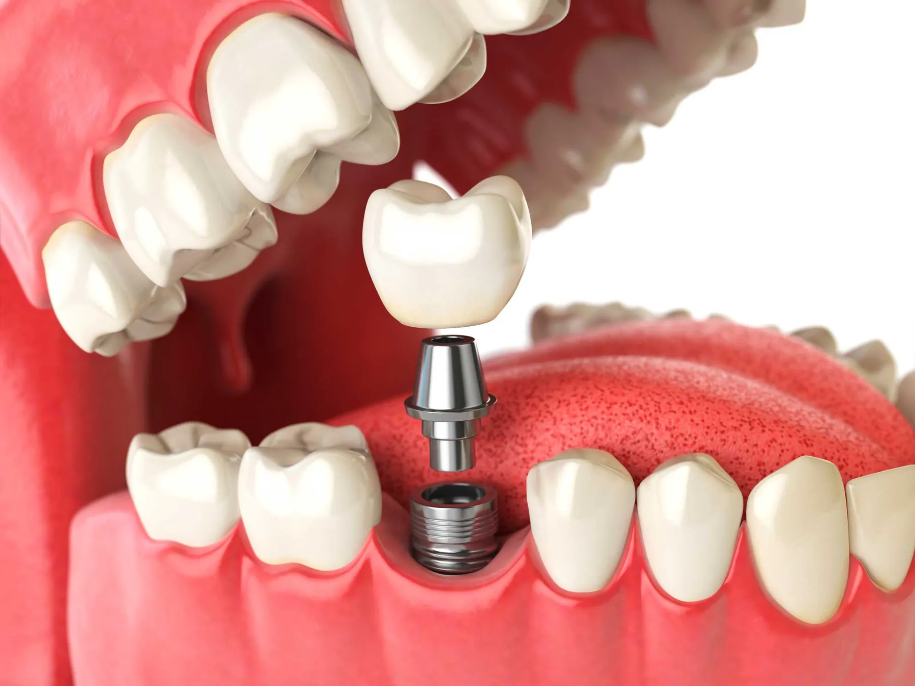 Implantes dentales