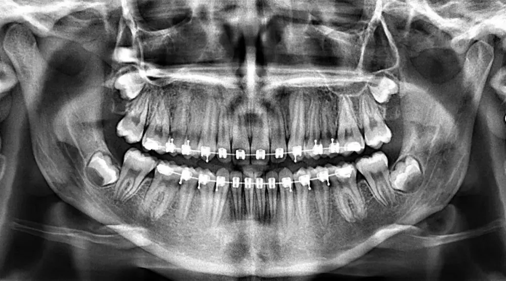 Endodoncia